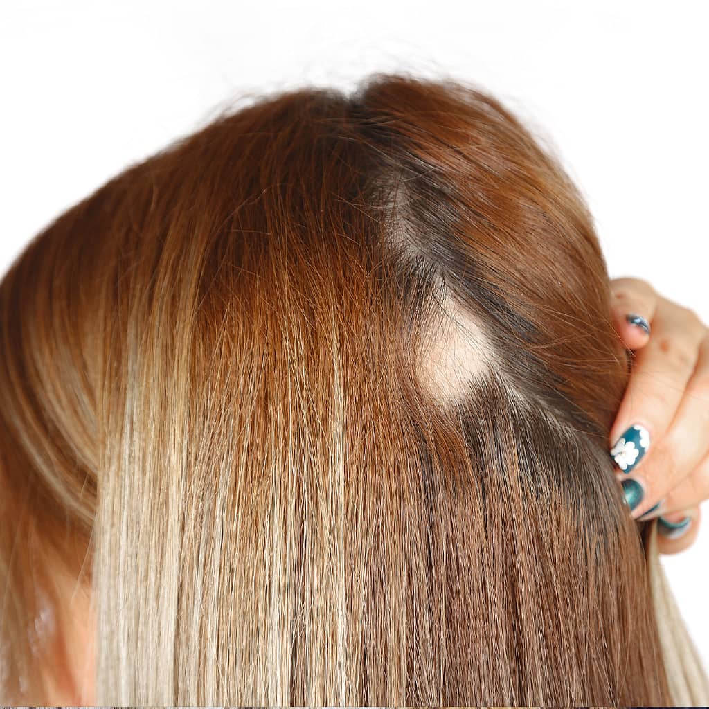 woman holding her hair back showing a bald spot on head caused by traction alopecia