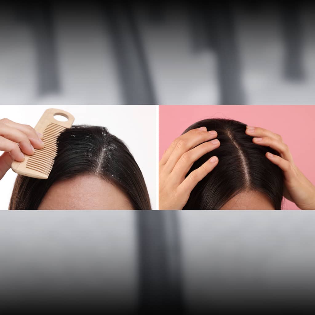 Side-by-side comparison of a person experiencing Itchy Scalp and Dandruff. On the left, dandruff flakes are visible as the person uses a comb. On the right, a person massages a clean scalp, representing relief from dry and itchy scalp conditions.